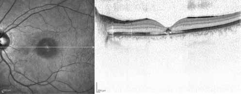 Muslubaş ve ark, Lazere ağlı Maküla Yanıkları doz intravitreal anti-vasküler endotelyal büyüme faktörü (VEGF) enjeksiyonu yapıldı. Hasta enjeksiyon sonrası 1. gün, 1. hafta, 1, 3 ve 6.