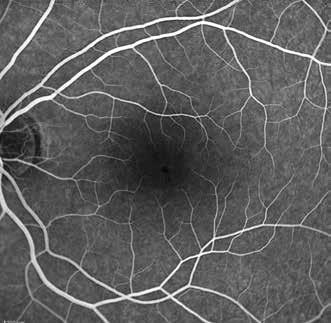 Fundus muayenesinde foveal lezyonun küçülmüş olduğu gözlendi (Resim 6). OKT incelemesinde, fovea atrofik görünümdeydi. ELM intaktı.