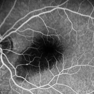 MP1 tetkikinde skotomun küçüldüğü, fiksasyonun santrale yaklaştığı ve rölatif unstabil olduğu izlenmekteydi. Retinal duyarlılık 16,8 d olarak ölçüldü (Resim 9).