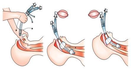 (gastric LMA)