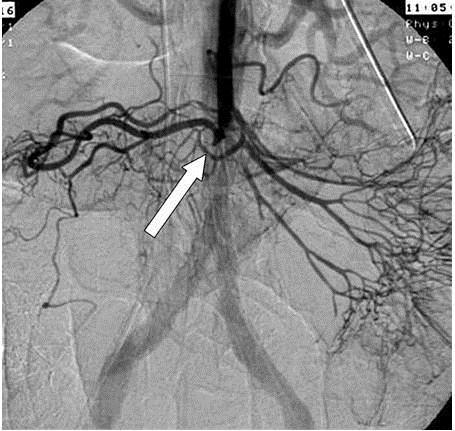 Orta kolik arterin