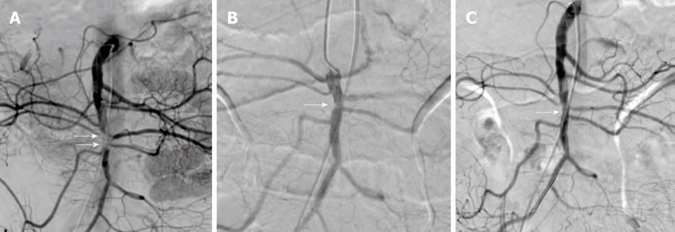 Birincil aspirasyon trombektomisi ve ilave stent implantasyonu ile üst mezenterik arterin orta gövdesinde fokal trombotik oklüzyonun başarılı bir şekilde tedavisi Hye Jin Yang.