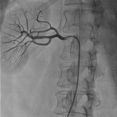 RAS anjiografi RAS anatomik tanısı için gold stantart Birincil görüntüleme yöntemi değildir. Non invaziv testler pozitifse tercih edilir.