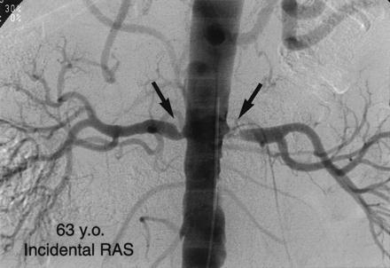 Bilateral renal stenozu Stephen C.