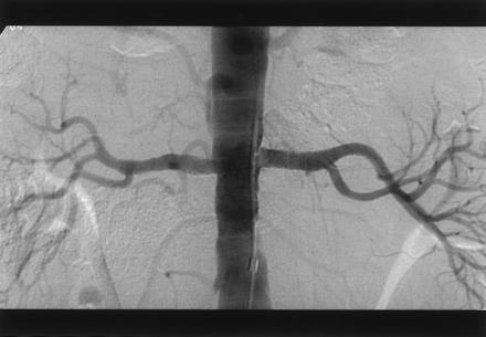 Progressive Hypertension in a Patient