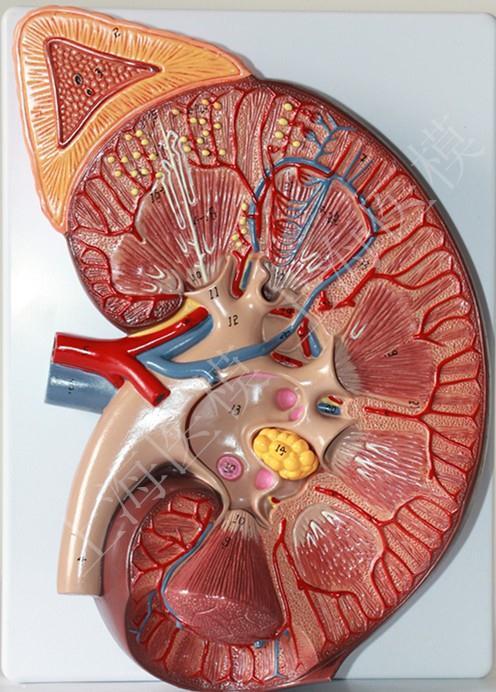 Renal ven trombozu Akut yan ağrısı Makroskopik hematüri Renal