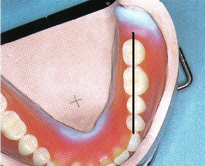 2. Mandibular Posterior DiĢlerin YerleĢtirilmesi Alt posterior diģler, protezin statiği açısından alveol kretini tam ikiye ayıran çizgi (kret üzeri) üzerine dizilmelidir. Resim 2.