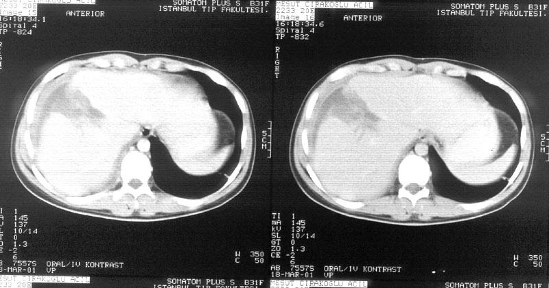 E. Özel teşhis yöntemleri Noninvaziv Ultrasonografi (USG) Bilgisayarlı tomografi (BT) İnvaziv Tanısal peritoneal lavaj (TPL) Tanısal laparoskopi (TL) Endoskopi Özel teşhis yöntemlerinin