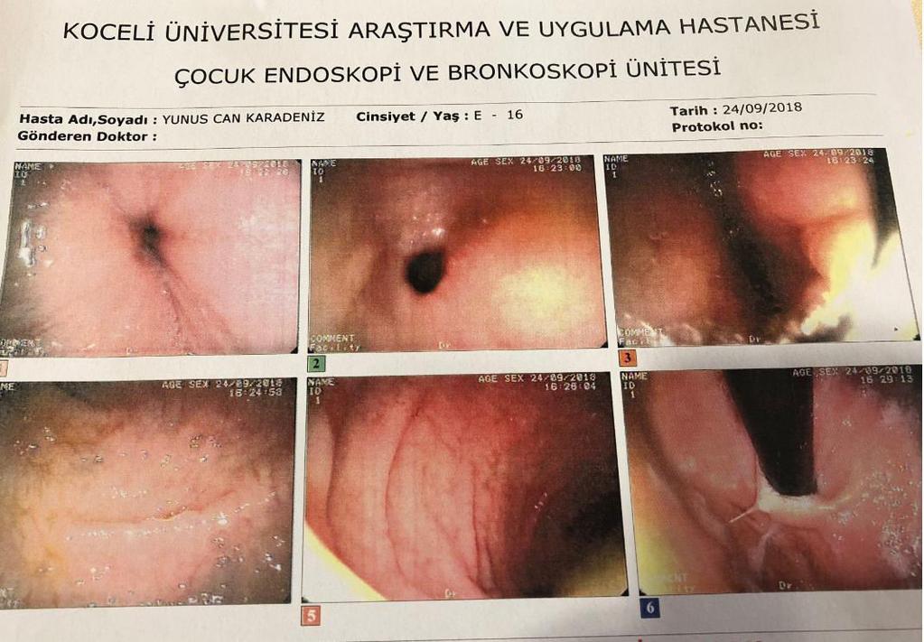 Antral nodülarite,bulbus ve duodenumda yaygın taraklanma