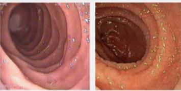 Normal Duodenum /