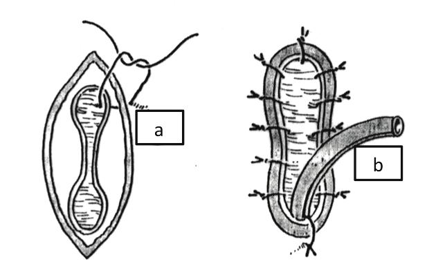 Bu amaçla pandüler uretradaki darlıklarda penoskrotal insizyonla (Şekil 1), bulbomembranöz darlıklarda konkavitesi aşağıya bakan perineo-skrotal ters Y insizyonu ile darlık bölgesine ulaşılır.