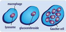 GBA eksikliği, akrofajları lizozo ları içinde glukoserebrosid ve diğer glikolipidlerin birikmesine yol açar. (Doku düzeyi 20 ila 100 kat artar.