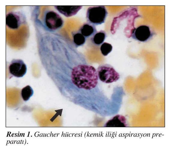 Gaucher hastalığı ı patolojik bulgusu: Ke ik iliği deki retiküloendotelyal sistem Gaucher hücresi Çapı -100 μm intrasitoplazmik substrat i klüzyo ları ı varlığı da kay akla a karakteristik uruşuk