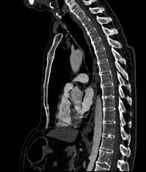 Akut dönemden sonra vertebral eklemlerde ve lateral ligamentlerde ossifikasyonlar