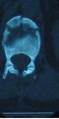 ve (b) yan X-ray, (c) tomografi ] sonucunda L1 burst kırığı olduğu saptanıyor.