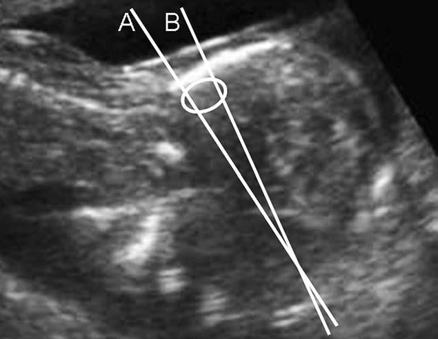 İzole yeni nesil dizileme ile yapılmış bir çalışma henüz yoktur. İzole VM'nin bazen tek gen hastalıklarının prenatal dönemdeki tek bulgusu olabileceği biliniyor. 4.