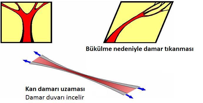 Shearing (makaslama) etkileri Shearing (makaslama) etkisi kan damarlarının gerilip