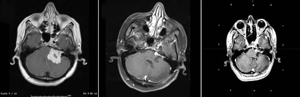 A b c Şekil 3: T1 ağırlıklı kontrastlı MRG lerde Koos 4 bir schwannoma (A), cerrahi tedavi ile nörolojik defisite yol açmayacak şekilde çıkarımı (B) ve takip eden 3.