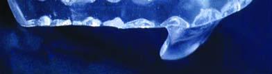 A b r e a t- hing hole, placing in the anterior portion of the appliance allow for easy breathing throughout the night (Figure 2).(14) 3.
