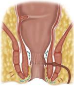 Enteroenterik, enterokutanöz, perianal, enterovezikal, enterovaginal, Lokalizasyon Enteroenterik, enterokutanöz, perianal, enterovezikal, enterovaginal, intersfinkterik, transsfinkterik,