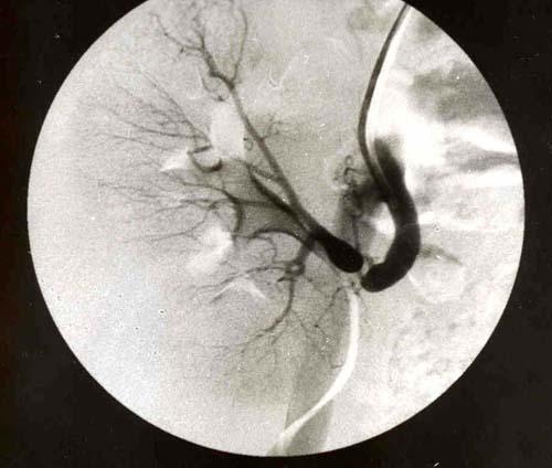 Renal arter stenozu Tedavi: Radyolojik girişim (%75) Balon anjioplasti Stent Cerrahi revizyon