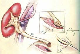 İdrar Kaçağı Tanı: Dren/dren yeri, insizyon akıntısı USG (batın sıvısı- aspirasyonu) Renal