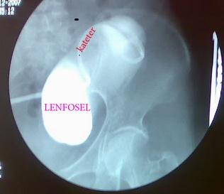 Lenfosel Tanı: USG Tedavi: 1. Perkütan iğne aspirasyonu 2. Perkütan drenaj kateteri 3.