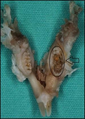 tamamen mukoza ile kapanmış olduğu tespit edildi (Resim 2). Ayrıca bu gruptaki 3 denekte diş çekim yapılan bölgeden püy akışı geldiği görüldü.