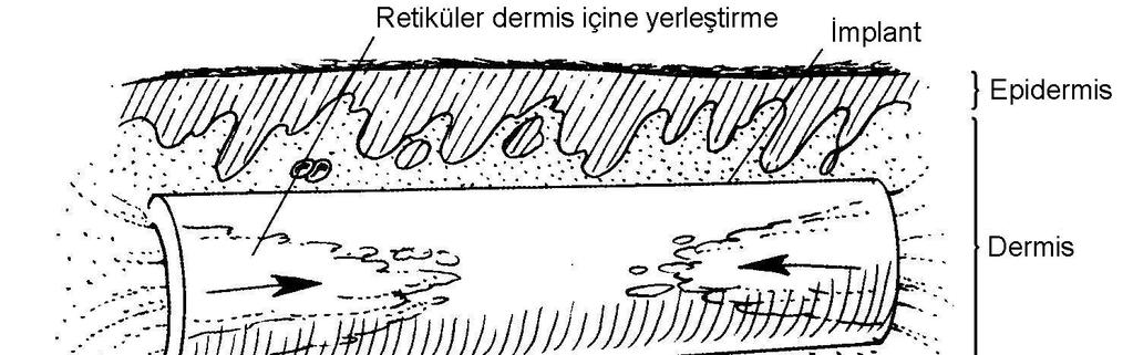 Şekil 16. SoftForm, orta dermise implante edilir. Hastanın dermal dokusu onu yerinde tutan tüp kısmına doğru yer değiștirebilir. maddesinin hatalı yerleştirilmesi olabilir.