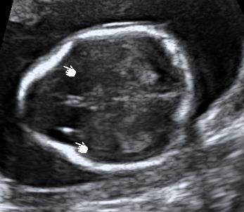bir fetusun