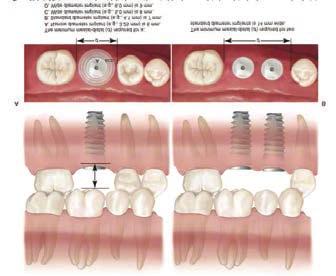 Diş Hekimliği Klinik Bilimler / D 10-3 46. Diş fırçalama tekniklerinden hangisinde vibrasyon uygulanır? 46 A A) Bass B) Modifiye stilmann C) Scrub D) Fone s E) Leonard VIBRASYON: Bass, Charter s 47.