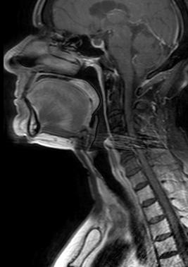 adeleler Medial pterygoid