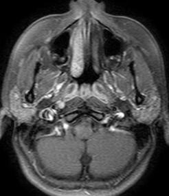 Lateral faringeal reses Rossenmüller