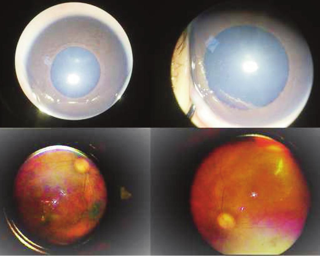 RESİM 2: Sağ ve sol gözün, intravitreal tedaviden bir gün sonraki ön segment ve binoküler indirek videooftalmoskop (Omega, Heine Optotechnik, Herrsching, Almanya) ile çekilen fundus resmi.