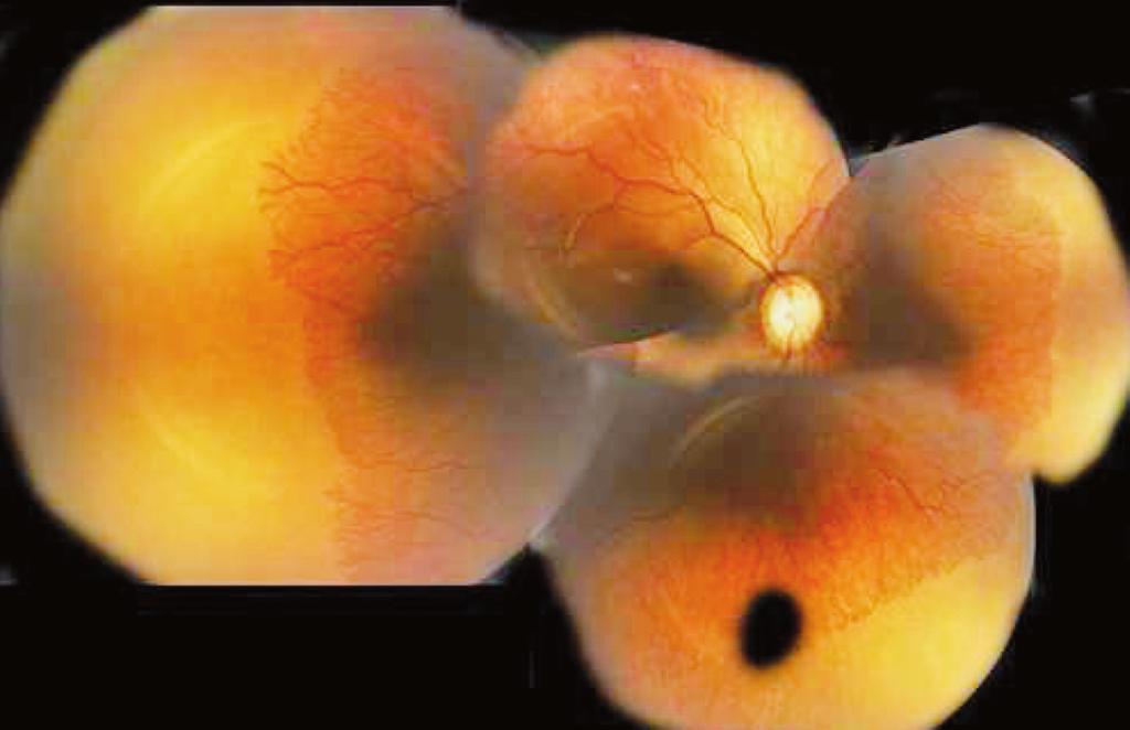 RESİM 3: Sağ gözün, intravitreal enjeksiyondan iki hafta sonra, geniş açılı dijital görüntüleme cihazı (ICON, Phoenix Clinical, Pleasanton, CA, ABD) ile çekilmiş fundus resmi.