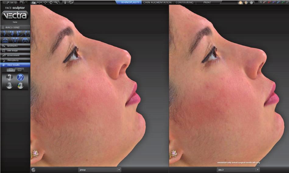 Lower lateral cartilage repositioning: objective analysis using 3-dimensional imaging. JAMA Facial Plast Surg 2014;16:261 7. 7. Hajeer MY, Ayoub AF, Millett DT.