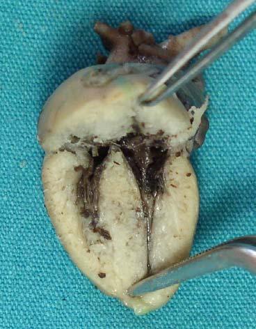Dışarı çıkarılan kalpte hem sağ-sol atrium duvarları (septum interatriale sağlam olacak şekilde) hem de apex-basis arası (ventriküller ön ve arka iki parça olacak şekilde sağ-sol ostium