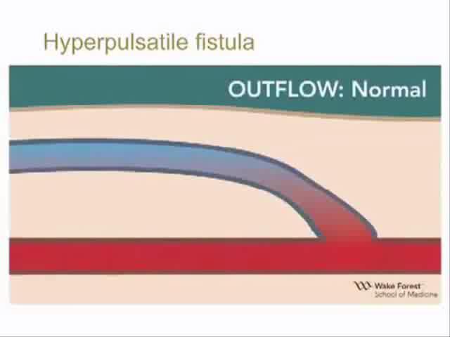 Normal Fistül Akımı Muayenede thrill