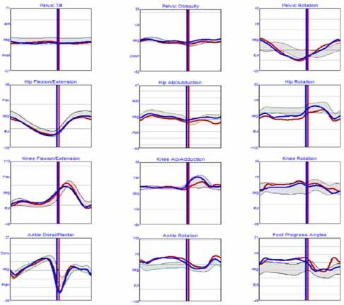 Üç boyutlu bilgisayarlı yürüme analizi: kinematik ve kinetik 339 ayrımı yapılabilmekte, tedavi algoritmaları belirlenebilmektedir.