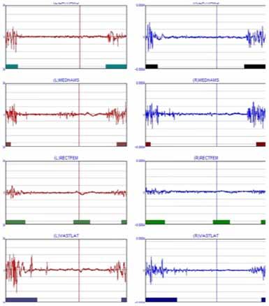 342 TOTBİD Dergisi Şekil 4. Dinamik EMG grafikleri. değildir. Hastanın değerlendirilmesi ve kayıtların alınması 2 2,5 saat, verilerin değerlendirilmesi ve raporlanması ise 1 2 saat sürer.