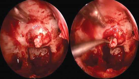 Şekil 8: ) Transsfenoidal endoskopik yaklaşımda dura açıldıktan sonra tümörün duradan dışarıya çıkması ve ) açılı halka küret yardımıyla tümörün boşaltılması. kasyonlar değerlendirilmiştir.