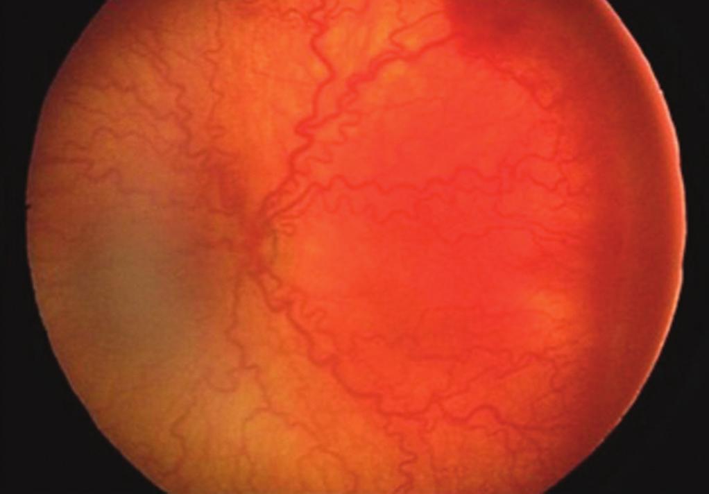 182 Prematüre Retinopatisi, Tanısı ve Değerlendirmede Standardizasyon Threshold (Eşik) Parametresi: Yine CRYO-ROP çalışma gurubu tarafından 1988 de tarif edilmiştir.