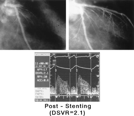 immediately after primary coronary