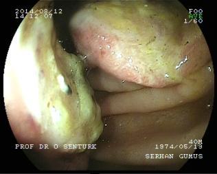 PROF DR O SENTURK KOCAELİ ÜNİVERSİTESİ GASTROENTEROLOJİ Aralık 2006- Eylül 2014 Anal yoldan yapılan enteroskopilerde ortalama işlem süresi 71,4 dk, ileoçekal