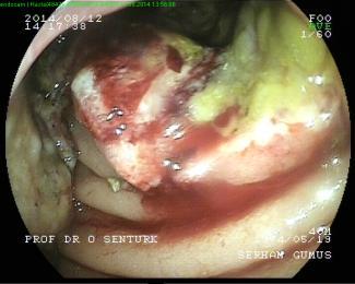 Pankreatit ve hiperamilazemi Paralitik ileus, epinefrin sonrası iskemi nekroz Polipektomi sonrası kanama, perforasyon Sonuç Oral ve anal DBE ile tüm GİS in