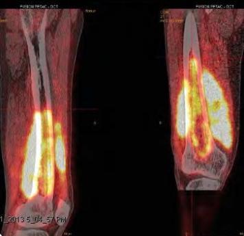 Klinik Çalışmalar-Distal femurda kronik osteomiyelit Hasta: 64