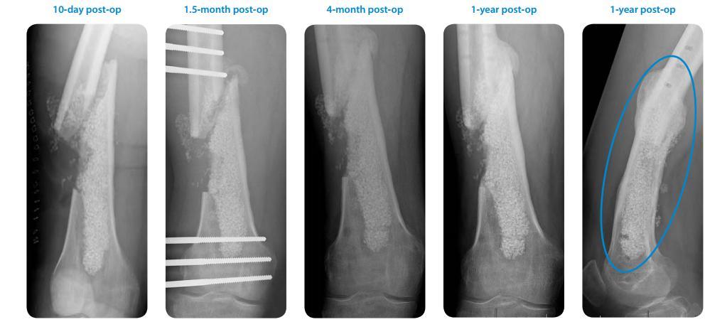 Klinik Çalışmalar-Distal femurda kronik osteomiyelit Bioactive glass S53P4 as bone graft substitute in treatment of osteomyelitis.