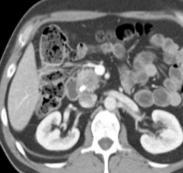 epitelinden köken alır (en sık adenokarsinom) Anatomik olarak 3