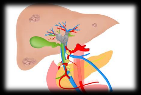 IDUS MRI/MRCP Kanal