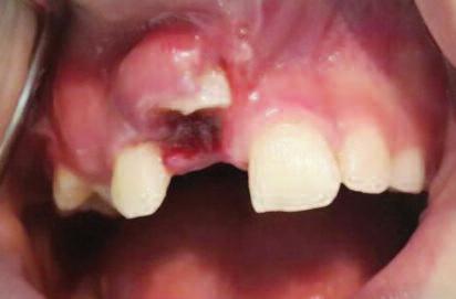 İbiş et al. İntrüziv lüksasyonların tedavisi planlanırken; hastanın yaşı, dentisyonun tipi, etkilenen dişin kök gelişim durumu, travmanın şiddeti ve üzerinden geçen süre göz önünde bulundurulmalıdır.